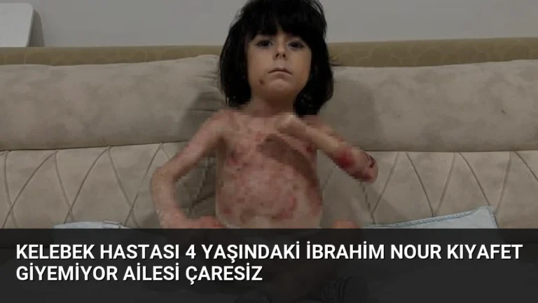 Kelebek Hastası 4 Yaşındaki İbrahim Nour Kıyafet Giyemiyor Ailesi Çaresiz