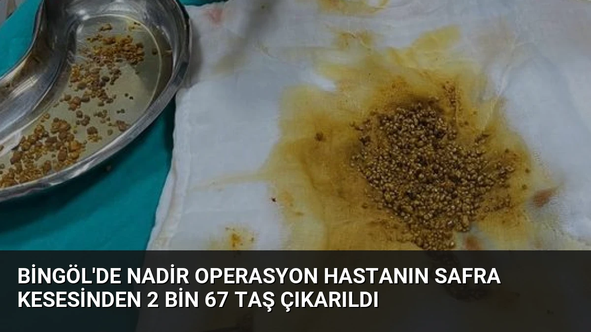 Bingöl’de Nadir Operasyon Hastanın Safra Kesesinden 2 Bin 67 Taş Çıkarıldı